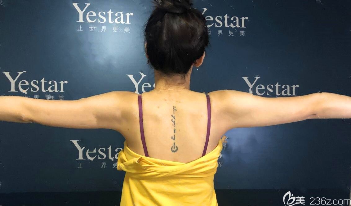 吸脂瘦手臂术前照 吸脂瘦手臂术前照