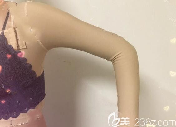 合肥艺星整形手臂吸脂术后第7天情况 合肥艺星整形手臂吸脂术后第7天情况