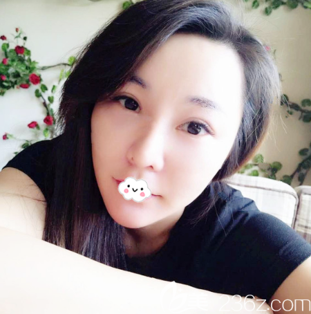 找广州星团医美廖均平做完童颜线雕埋线提升后,不仅脸变立体饱满了皮肤也越来越紧致了