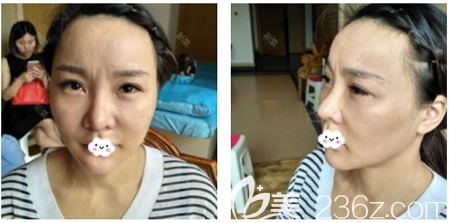 在广州星团医美做童颜线雕术前照片 在广州星团医美做童颜线雕术前照片