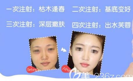 水光注射核心优势