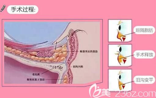 眶隔脂肪释放祛眼袋