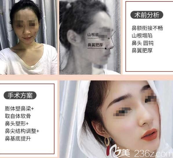 胡斌医生肋软骨隆鼻案例