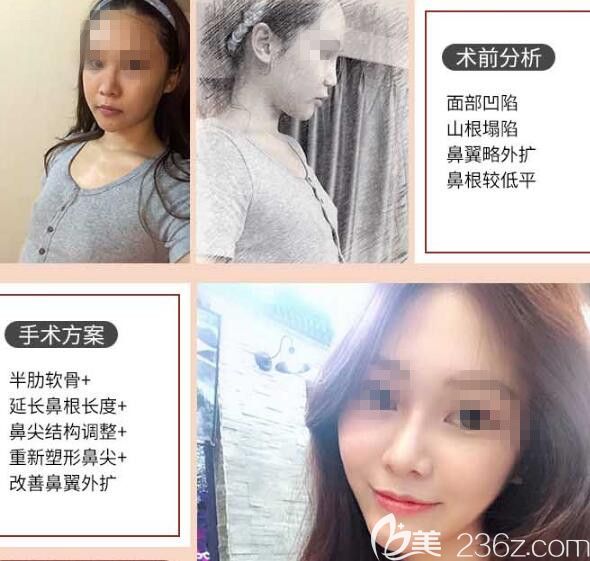 胡斌医生肋软骨隆鼻案例2