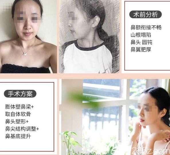 郑州医德佳肋软骨隆鼻案例