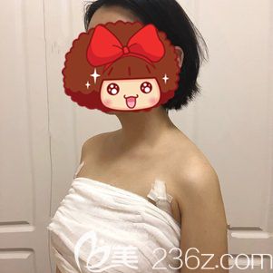 朱胜军医生帮我做自体脂肪隆胸术后5天胸部饱满