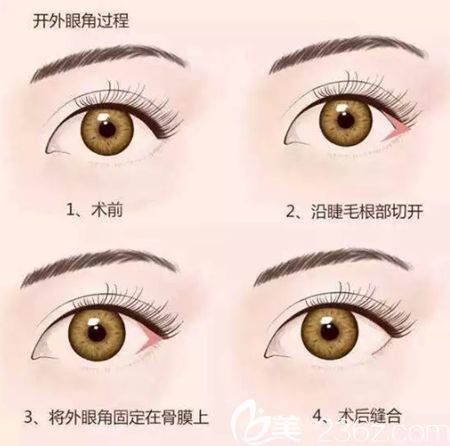 韩国纯真崔宰源院长回答开了外眼角会不会回缩呢