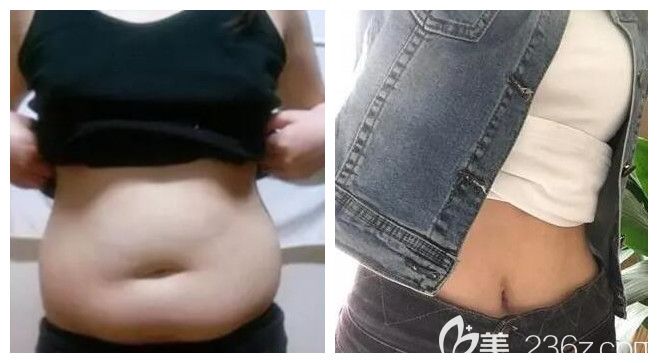 南宁梦想整形唐超医生腰腹部吸脂案例