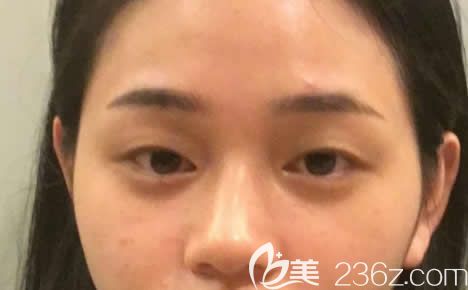 做双眼皮和开眼角之前 做双眼皮和开眼角之前