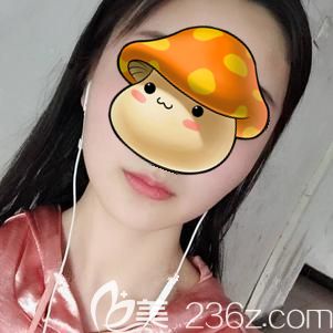 做假体垫下巴术后7天拆线肿胀消除 做假体垫下巴术后7天拆线肿胀消除