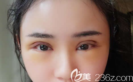 做完全切双眼皮7天恢复<span style= 做完全切双眼皮7天恢复<span style=