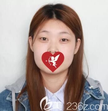 做双眼皮开眼角眼综合术前照 做双眼皮开眼角眼综合术前照