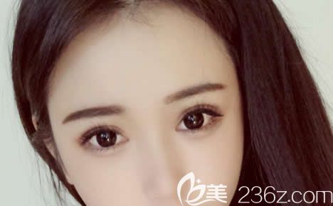 杭州艺星杨连华双眼皮<span style= 杭州艺星杨连华双眼皮<span style=