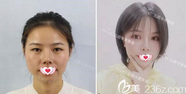 切开双眼皮+提肌+去脂手术 切开双眼皮+提肌+去脂手术