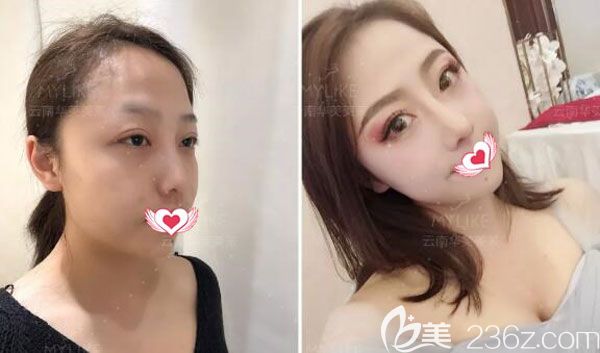 美莱肋软骨隆鼻+硅胶隆鼻案例效果 美莱肋软骨隆鼻+硅胶隆鼻案例效果