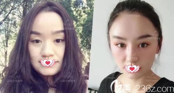 华美美莱做自体脂肪全脸填充案例效果对比图 华美美莱做自体脂肪全脸填充案例效果对比图