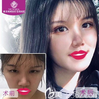 张家口维多利亚做双眼皮手术案例 张家口维多利亚做双眼皮手术案例