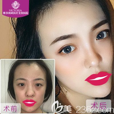 张家口维多利亚做隆鼻手术案例 张家口维多利亚做隆鼻手术案例