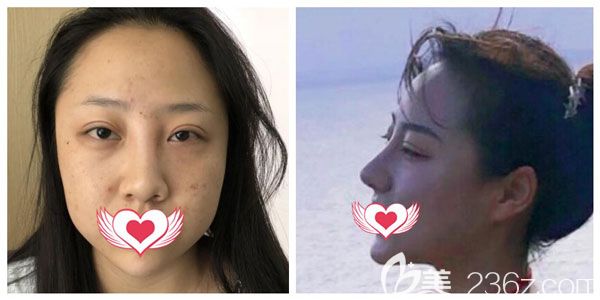 华美美莱玻尿酸隆鼻案例效果 华美美莱玻尿酸隆鼻案例效果