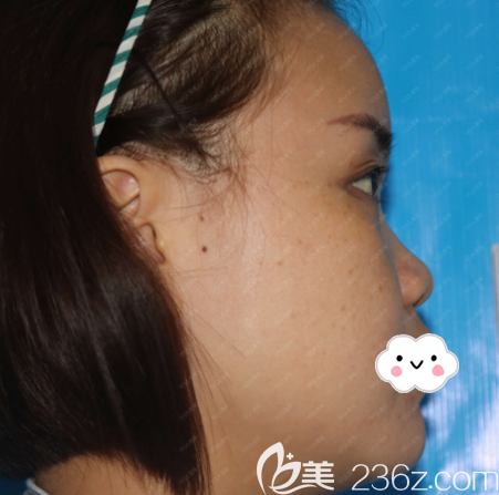 在东莞壹加壹做隆鼻术前照片 在东莞壹加壹做隆鼻术前照片