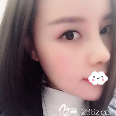 肋软骨鼻综合隆鼻术后15天恢复过程图 肋软骨鼻综合隆鼻术后15天恢复过程图