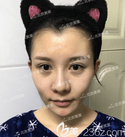 我在北京美莱做PRP全脸脂肪填充前样子 我在北京美莱做PRP全脸脂肪填充前样子