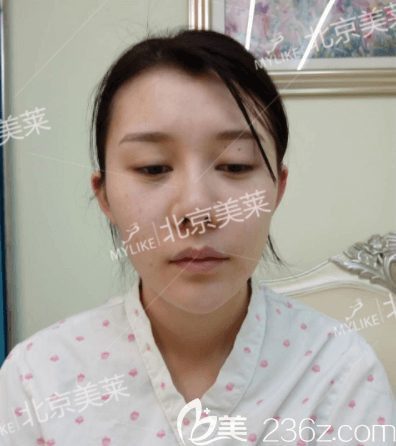 <!--<i data=20240703-sp></i>-->医生给我做PRP全脸脂肪填充手术前照 <!--<i data=20240703-sp></i>-->医生给我做PRP全脸脂肪填充手术前照