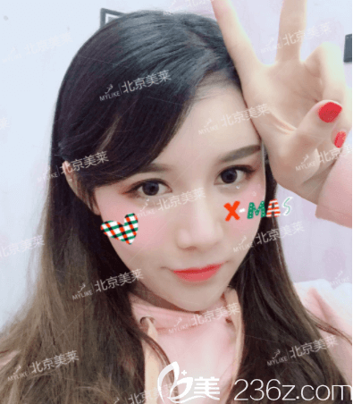 美莱<!--<i data=20240703-sp></i>-->做脂肪填充怎么样?我在北京美莱做PRP全脸脂肪填充第35天效果参考 美莱<!--<i data=20240703-sp></i>-->做脂肪填充怎么样?我在北京美莱做PRP全脸脂肪填充第35天效果参考