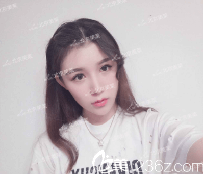 北京美莱PRP全脸脂肪填充案例 北京美莱PRP全脸脂肪填充案例