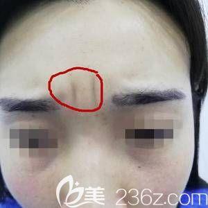 额头上已经有了深深的川字纹 额头上已经有了深深的川字纹