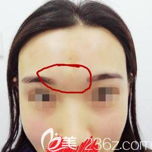 刚注射完的照 刚注射完的照