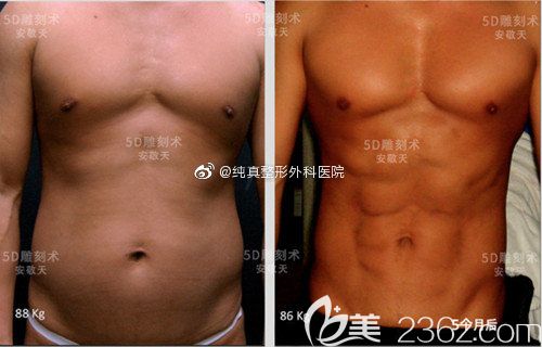 韩国安敬天院长腰腹吸脂打造腹肌案例