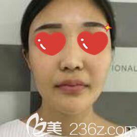 做玻尿酸填充面部术前照 做玻尿酸填充面部术前照