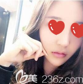 在斯美诺做玻尿酸填充面部术后2天效果 在斯美诺做玻尿酸填充面部术后2天效果