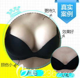 德州天宏假体隆胸案例