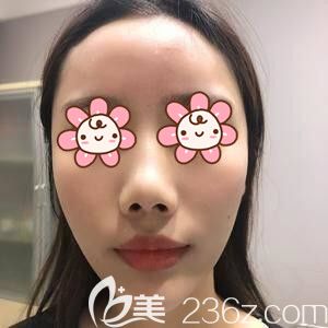 在长沙注射玻尿酸丰额头术后即刻效果