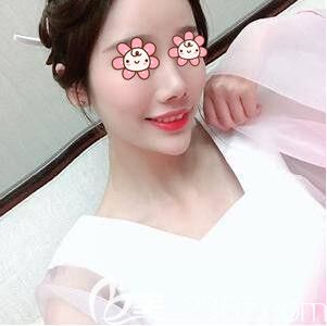 在长沙艺星注射玻尿酸丰额头术后半个月效果图