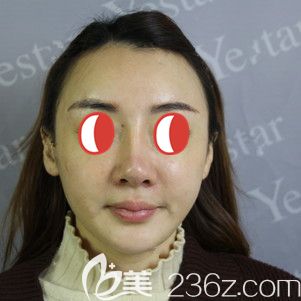 到武汉艺星做鼻部修复术前自己的鼻子 到武汉艺星做鼻部修复术前自己的鼻子