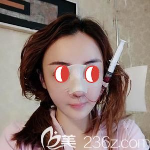 杨国梁院长帮我做鼻部修复术后即刻 杨国梁院长帮我做鼻部修复术后即刻