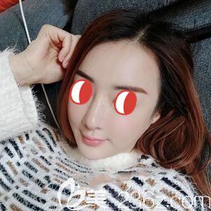 做鼻部修复术后15天肿胀消除疤痕渐消 做鼻部修复术后15天肿胀消除疤痕渐消