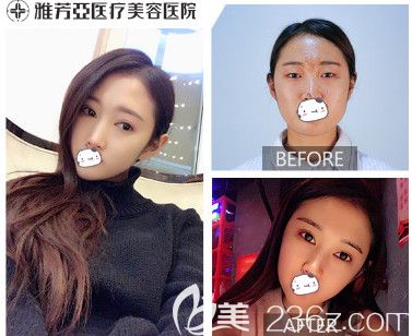 石家庄雅芳亚双眼皮整形案例