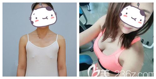 雅芳亚整形隆胸案例