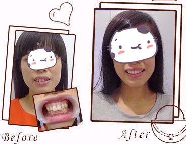 石家庄雅芳亚氧化皓美容冠案例对比