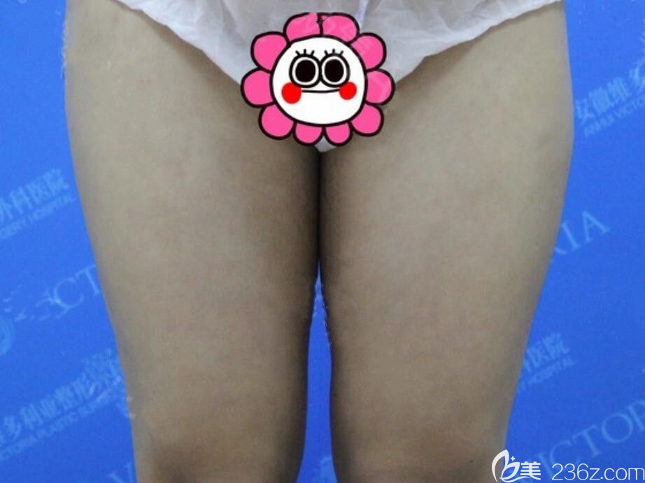 找安徽维多利亚卫爱侠做大腿吸脂前 找安徽维多利亚卫爱侠做大腿吸脂前