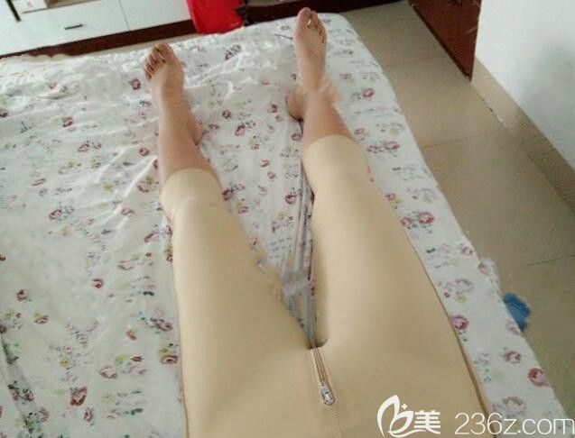 卫爱侠大腿抽脂第4天照片 卫爱侠大腿抽脂第4天照片