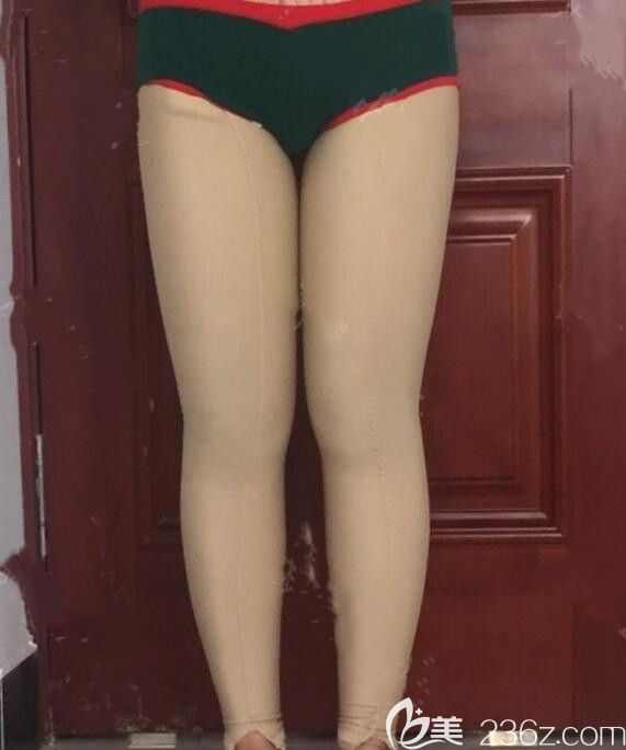 吸脂瘦大腿术后第7天恢复情况 吸脂瘦大腿术后第7天恢复情况