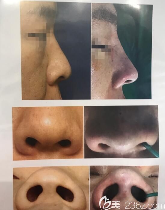 鼻修复面诊韩国nano高配版的Glory整形，价格800w起感觉院长分析不错单案例不吸引人