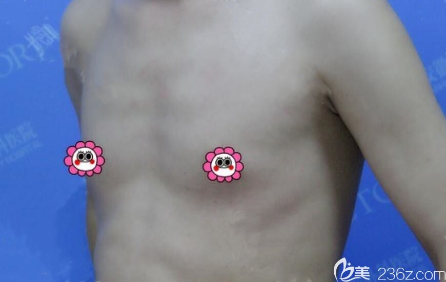 选择曼托假体隆胸前 选择曼托假体隆胸前