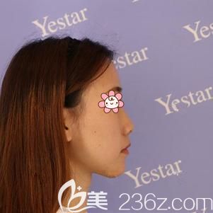 到武汉艺星面诊前山根低鼻子塌的自己 到武汉艺星面诊前山根低鼻子塌的自己