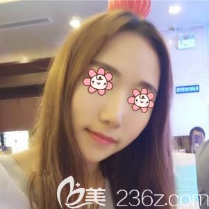 做膨体隆鼻术后9天鼻子肿胀消除 做膨体隆鼻术后9天鼻子肿胀消除